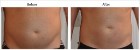 ✨Massage réducteur et lipocavitation ✨