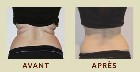 ✨Massage réducteur et lipocavitation ✨