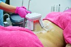  Lifting colombien Augmenter le volume fessiers
