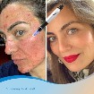 ✨ Traitements Botox & Acide Hyaluronique ✨