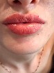   Botox &agrave; 8$ et L&egrave;vres  Parfaites &agrave; 300$! 
